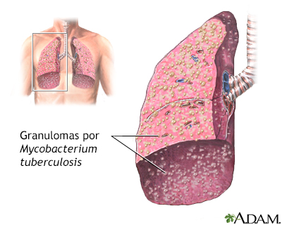 Tuberculosis miliar - Miniatura de ilustración
              