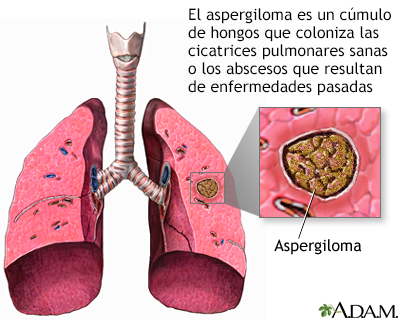 Aspergiloma