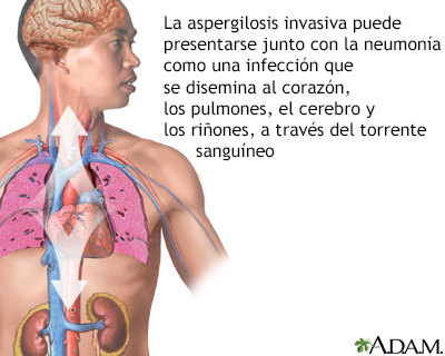 Aspergilosis pulmonar - Miniatura de ilustración
              