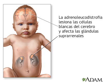 Adrenoleucodistrofia neonatal - Miniatura de ilustración
              
