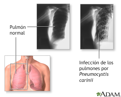 Neumocistosis