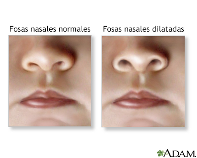 Dilatación de las fosas nasales - Miniatura de ilustración
              