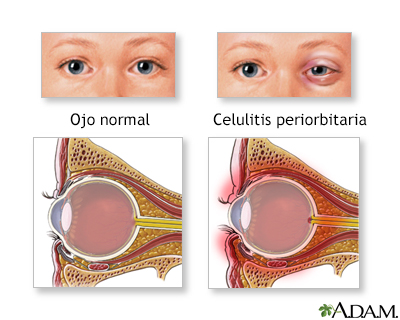 Celulitis periorbital