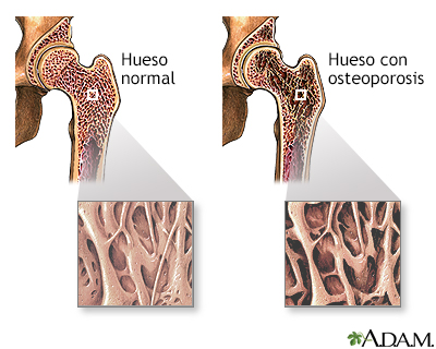 Osteoporosis - Miniatura de ilustración
              