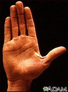 Anatomía de la superficie de la palma de la mano normal - Miniatura de ilustración
              