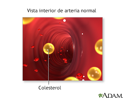 Bloqueo en la arteria carótida interna - Miniatura de ilustración
              