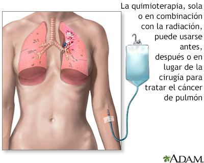 Tratamiento con quimioterapia - cáncer pulmonar - Miniatura de ilustración
              