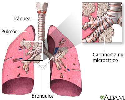 Carcinoma no microcítico - Miniatura de ilustración
              