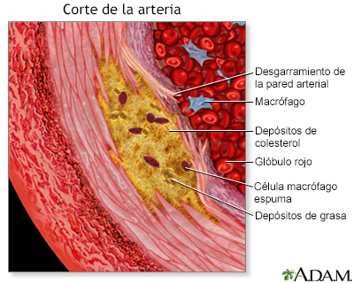 Vista agrandada de la aterosclerosis - Miniatura de ilustración
              