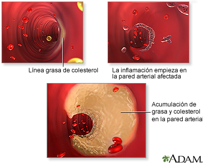 Acumulación de placa arterial