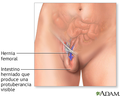 Hernia femoral - Miniatura de ilustración
              