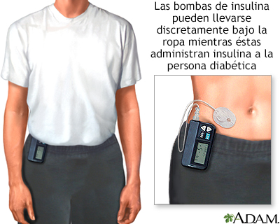 bomba de insulina para tratamiento de diabetes tipo 1 bomba de insulina para tratamiento de diabetes tipo 1