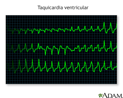Taquicardia ventricular - Miniatura de ilustración
              