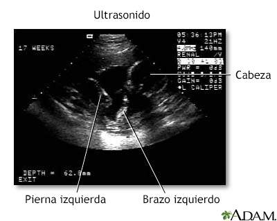 Ultrasonido de los ventrículos del cerebro en fetos normales