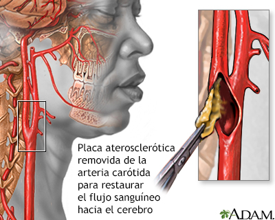 Endarterectomía - Miniatura de ilustración
              