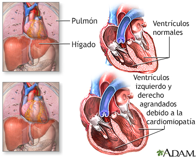Cardiomiopatía alcohólica - Miniatura de ilustración
              