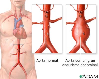 Aneurisma aórtico - Miniatura de ilustración
              