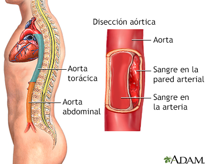 Disección aórtica