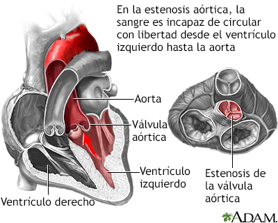 Estenosis aórtica