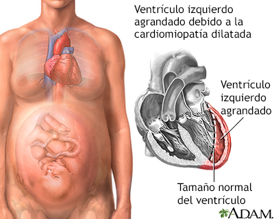 Cardiomiopatía periparto
