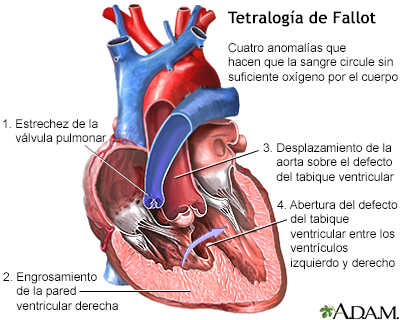 Tetralogía de Fallot - Miniatura de ilustración
              