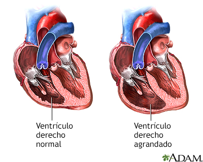 Regurgitación tricuspídea