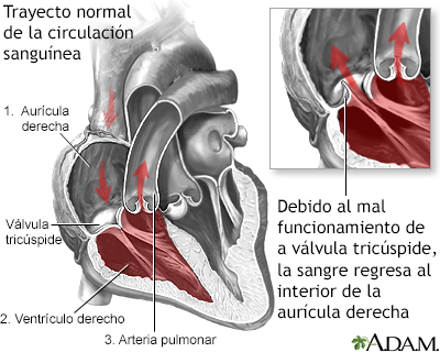 Regurgitación tricuspídea