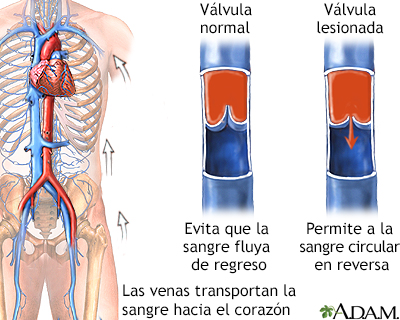 Insuficiencia venosa