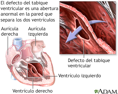 Defecto del tabique ventricular