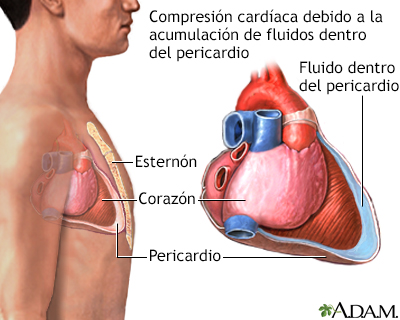 Taponamiento cardíaco - Miniatura de ilustración
              