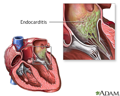 Endocarditis de cultivo negativo - Miniatura de ilustración
              