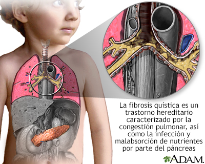 Fibrosis quística - Miniatura de ilustración
              