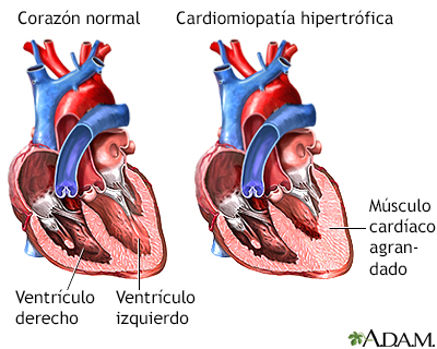 Cardiomiopatía hipertrófica