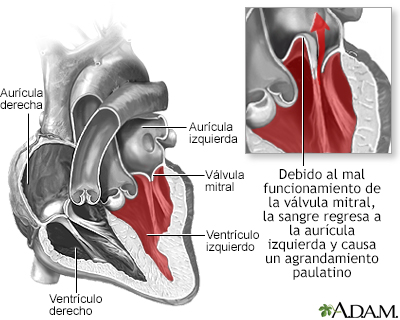 Prolapso da valva mitral