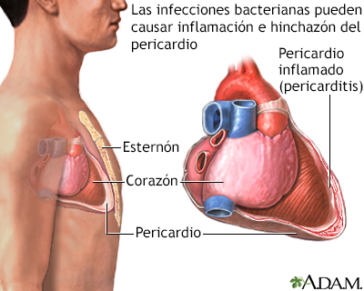 Pericarditis bacteriana