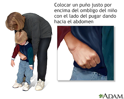 Maniobra de Heimlich en niños conscientes