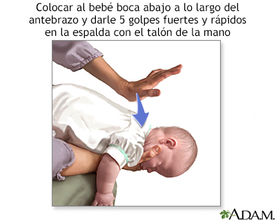 Maniobra de Heimlich en bebés - Miniatura de presentación
              