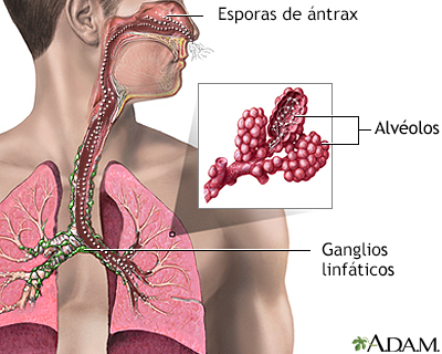 Inhalación de ántrax