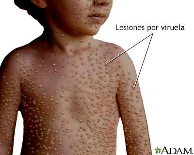 Lesiones por viruela