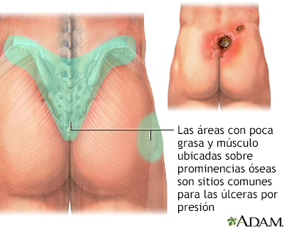 Áreas donde se presentan las úlceras de presión - Miniatura de ilustración
              