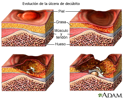 Progresión de la úlcera de decúbito