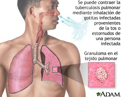Tuberculosis pulmonar - Miniatura de ilustración
              