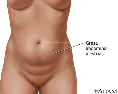 6.- Abdominoplastia: ¿Una persona con sobrepeso se puede realizársela?