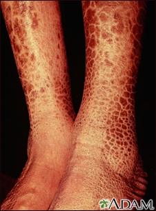 Ictiosis, adquirida - piernas - Miniatura de ilustración
              