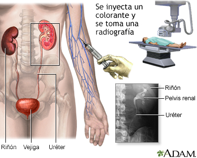 Pielograma intravenoso (PIV) - Miniatura de ilustración
              