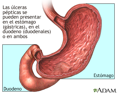 Ubicación de las úlceras pépticas