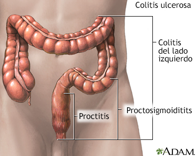 Colitis ulcerativa - Miniatura de ilustración
              