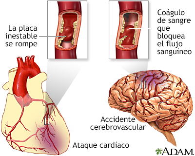 Acumulación de placa en las arterias