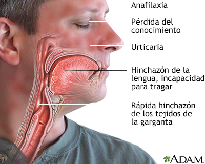 Spanish HIE Multimedia - Alergia alimentaria