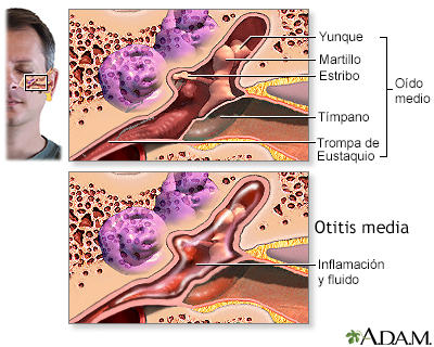 Infección del oído medio (otitis media) - Miniatura de ilustración
              